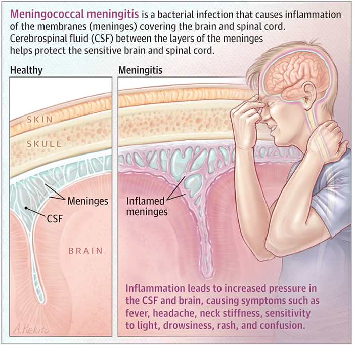 meningite da meningococco: sierotipi, cause, trasmissione, vaccini